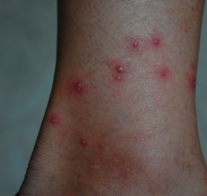 Fire ant bites on ankle 09-25-2010